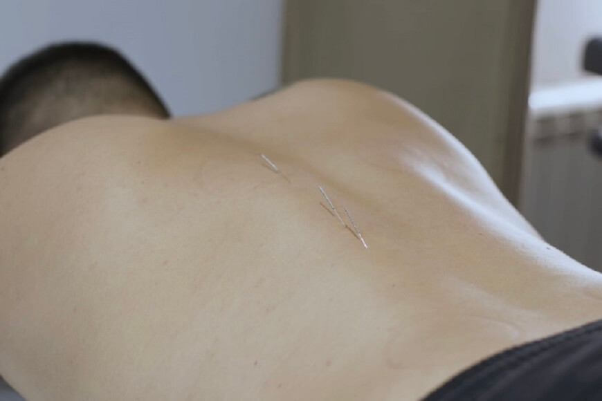 Dry needling, Physical therapy Belgrade