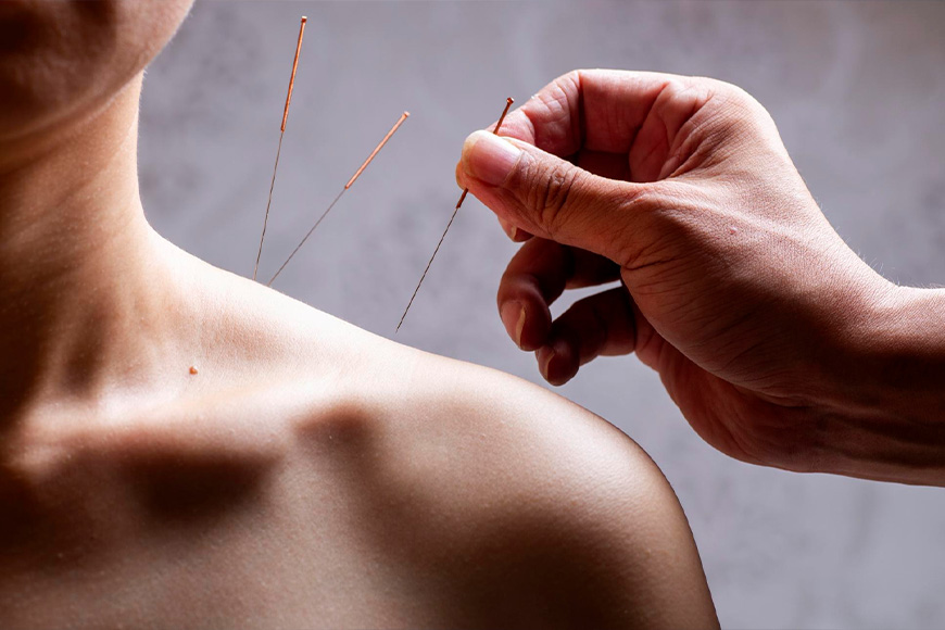 Fizikalna terapija Beograd | Dry needling