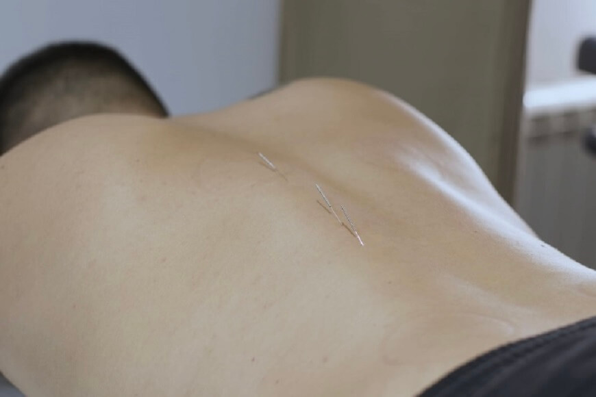 Dry needling, Fizikalna terapija Beograd